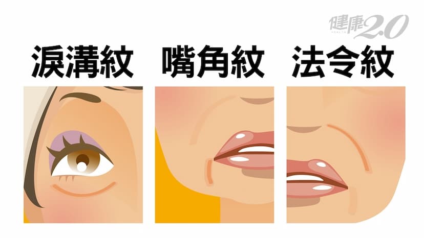 法令紋、嘴角紋、淚溝紋害你老10歲！除「三八紋」防衰老術/regimen/310505