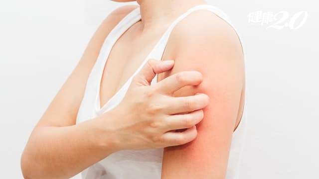 夏季皮膚癢？3種水果是禁區、4個生活法寶要備齊/regimen/310780
