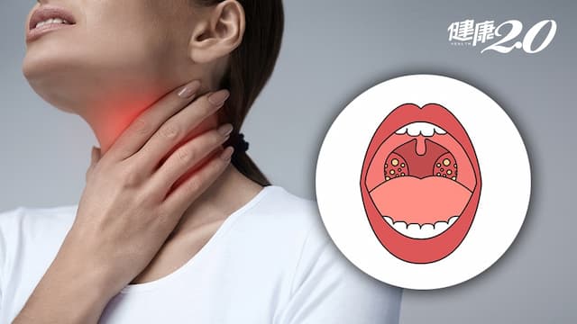 結石卡喉怎麼辦？扁桃腺反覆發炎，需要割嗎？