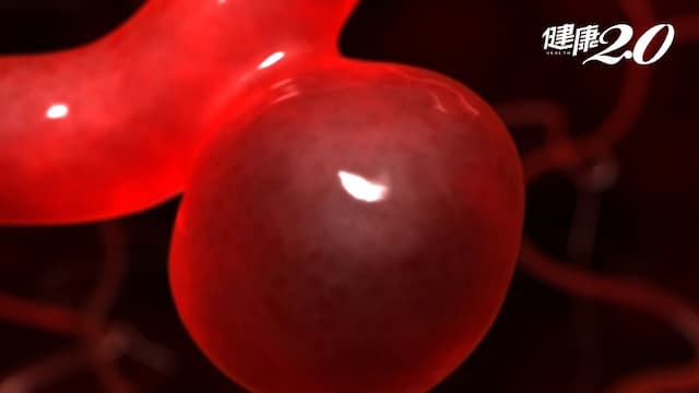 你應該要害怕3大奪命腦中風！這些人更要小心動脈瘤破裂