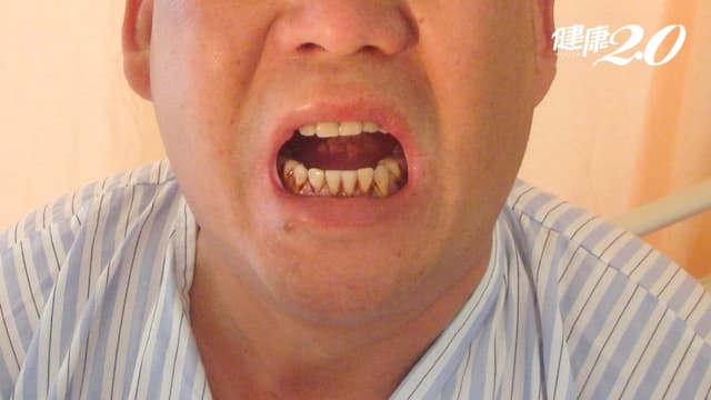 嗜吃檳榔導致口腔病變、連吃飯都有問題 跨科團隊合力再造自信人生/medical/315053