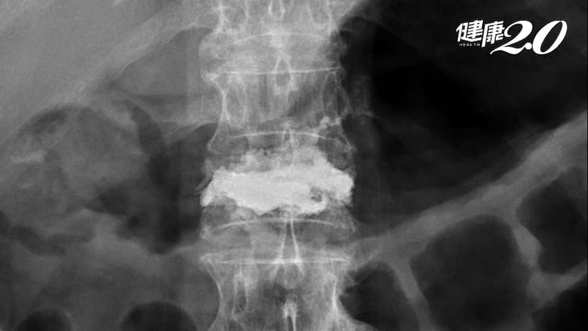 96歲婦人一跌就骨折、腰椎劇痛數個月…半小時灌「骨水泥」不痛了/medical/315227