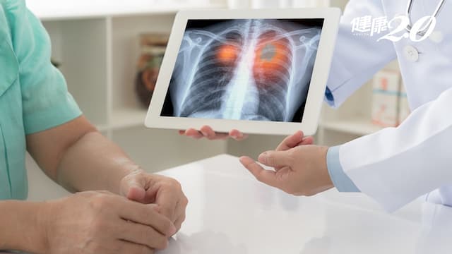 肺腺癌專找女性、非吸菸者 晚期患者「標靶接力」腫瘤縮小8成