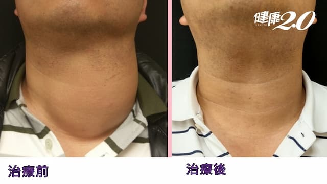 治療「大脖子」甲狀腺囊腫 新療法免開刀，又能保有腺體功能