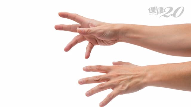 「可以幫我找手嗎？」思覺失調症是大腦生病了 藥物可控制