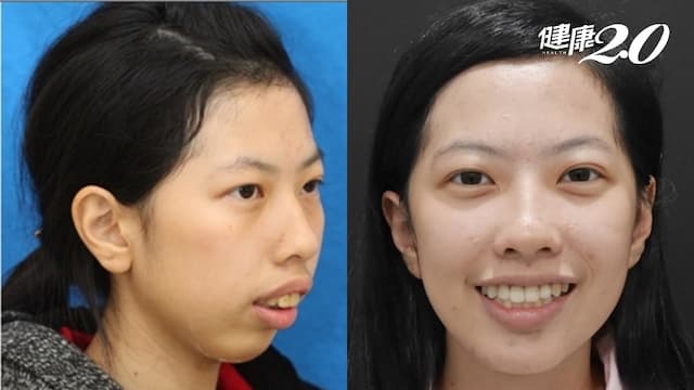 暴牙臉歪讓她睡不好、沒自信 「顳顎關節」3階段治療奏效！