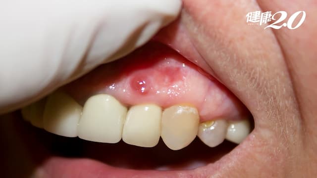 牙齦發黑潰瘍？原因可能出在這裡/medical/318634