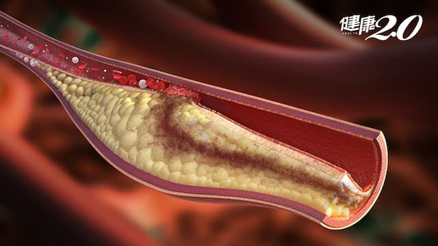 高血脂只靠運動、清淡飲食就能控制？醫：錯誤迷思！降膽固醇得這樣