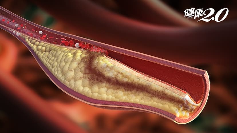 高血脂只靠運動、清淡飲食就能控制？醫：錯誤迷思！降膽固醇得這樣/medical/318799