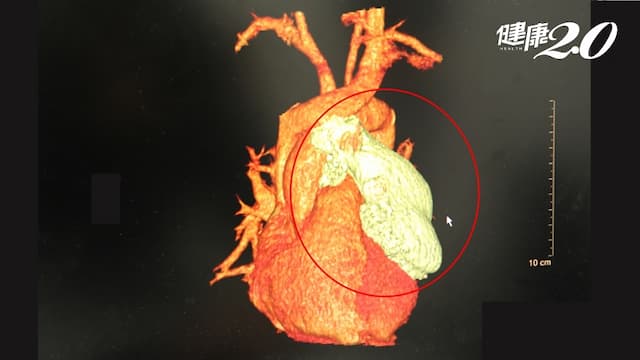 他健檢發現「胸腺瘤」，身體完全不痛 醫：眼皮下垂、手腳無力警戒