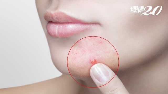 為什麼你還在長痘痘？你以為痘痘會自己好？聽醫師怎麼說/medical/322534