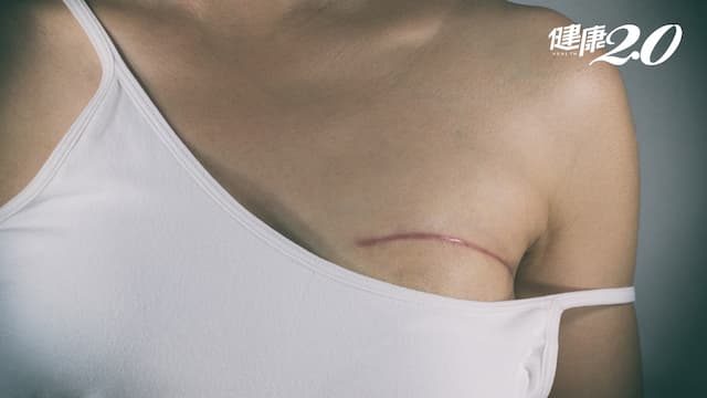 乳房切除後不美觀？新型手術保留乳頭、重建手術也同步完成/medical/322975