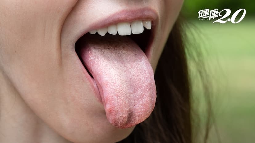 嘴巴有小白點，刷牙可以刷掉，但隔天又出現…是白斑症？還是口腔癌？/medical/323001