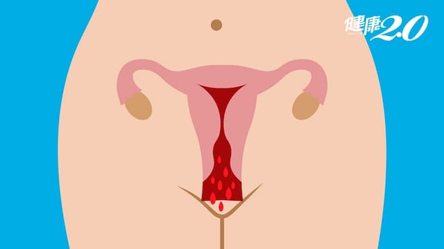 陰道出血可能是癌！醫分析：育齡婦女、更年期、停經後女性病因不同/medical/324417