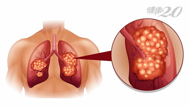 「肺癌」存活率10大癌症最低，不抽菸也會得！5招降低70％罹癌風險