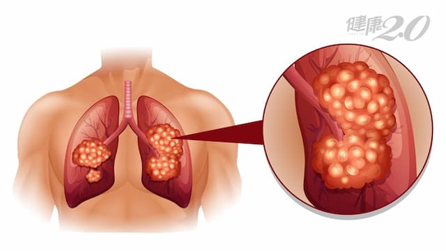 「肺癌」存活率10大癌症最低，不抽菸也會得！5招降低70％罹癌風險/medical/324669