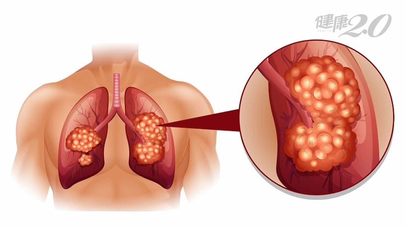 「肺癌」存活率10大癌症最低，不抽菸也會得！5招降低70％罹癌風險/medical/324669