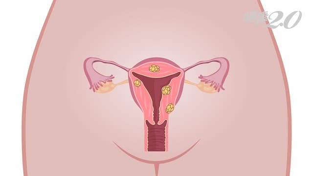 治療「子宮肌瘤」可以不開刀！新療法隔著肚皮除腫瘤 當天可出院
