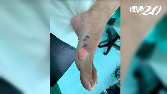 痛風患者小心「痛風石」惹來截肢！怎麼消除痛風石？