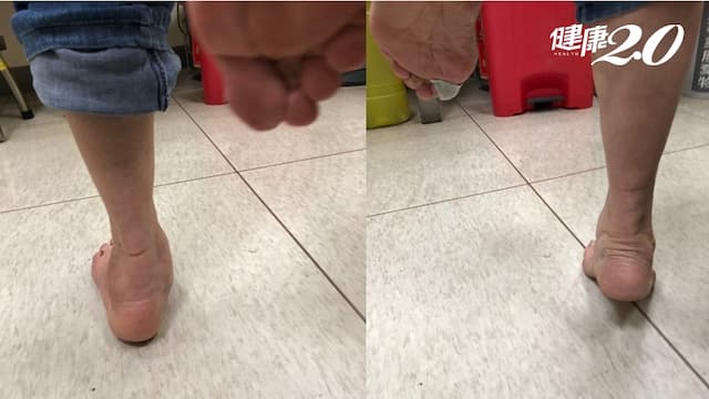 腳底痛可能不是足底筋膜炎！1招辨別後天性扁平足