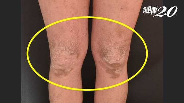 光照治療可治異位性皮膚炎，多曬太陽有用嗎？治療關鍵QA醫師解答/medical/325630