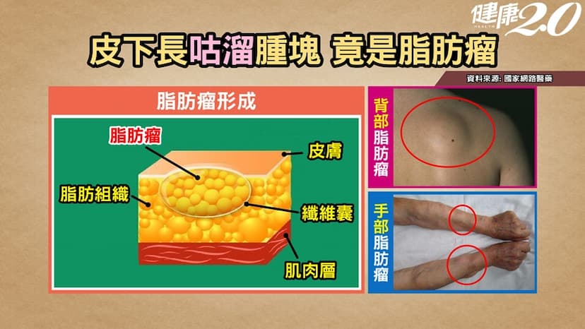 賀軍翔「頭部長瘤」，脂肪瘤會不會變癌？中醫：2飲茶調理脂肪瘤體質/review/325980