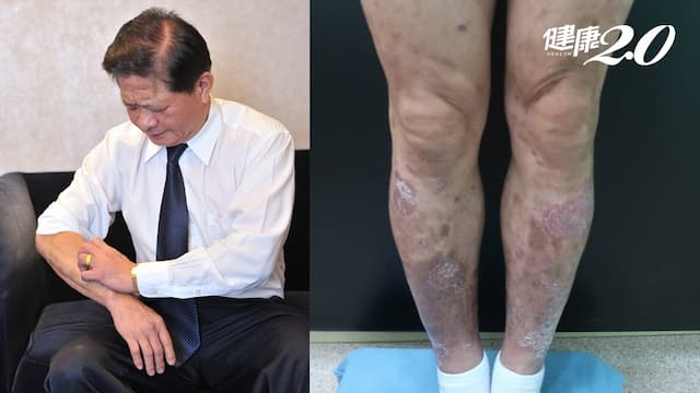 他罹乾癬全身皮膚乾裂、脫屑逾20年！醫師建議1治療 皮膚變乾淨了