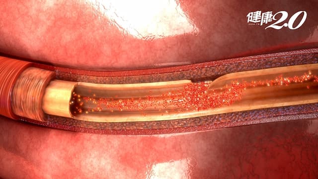 低溫慎防「主動脈剝離」死亡率每小時增1％…這年齡男性最好發