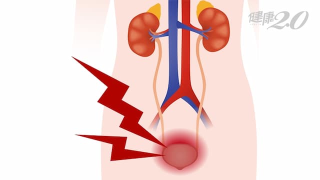 他斷斷續續血尿不會痛，1年後發現膀胱癌！30年的習慣就是「致癌因子」/medical/326534