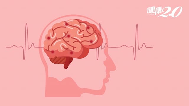 天冷注意腦中風！神經科醫師：做到5件事防中風！中風可以篩檢嗎？/medical/326671