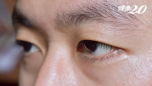 男子視力模糊找不到原因，竟是「甲狀腺亢進」造成！