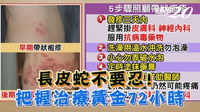 李亞萍曾過勞長皮蛇！醫曝罹帶狀疱疹2件事勿做 把握治療黃金72小時/review/330739