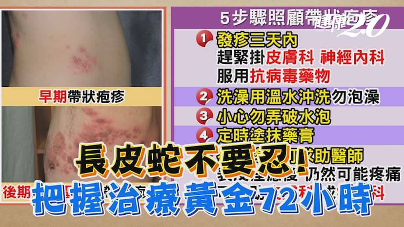 李亞萍曾過勞長皮蛇！醫曝罹帶狀疱疹2件事勿做 把握治療黃金72小時/review/330739