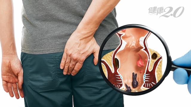 痔瘡手術後到底要痛多久？開刀前做「1件事」有效降低疼痛感/medical/330985