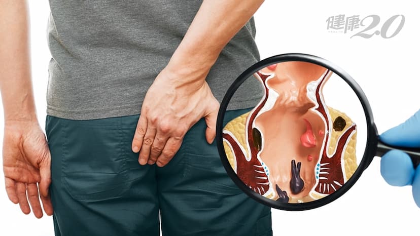 痔瘡手術後到底要痛多久？開刀前做「1件事」有效降低疼痛感/medical/330985