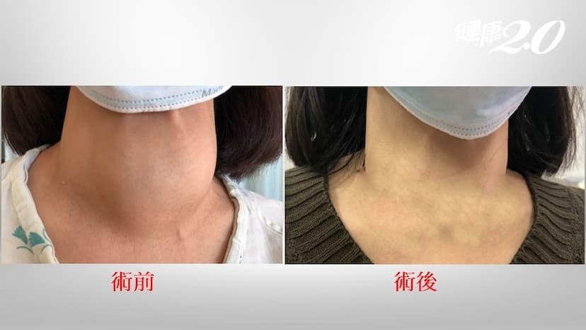 脖子太粗被盯著看，主管罹「甲狀腺結節」開會超尷尬！這手術可不留疤、不傷聲帶/medical/334238