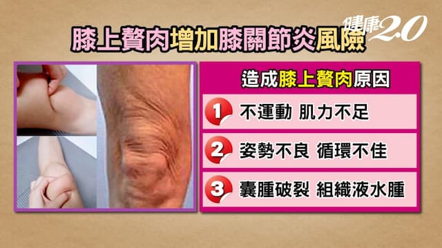 膝蓋上的富貴包恐釀肌無力、關節積水！1動作降46％風險，小心3個動作害你痛！/review/334726