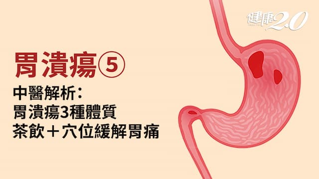 胃潰瘍／胃不好體質有3種！中醫保護胃黏膜：3個顧胃奇穴＋保健茶