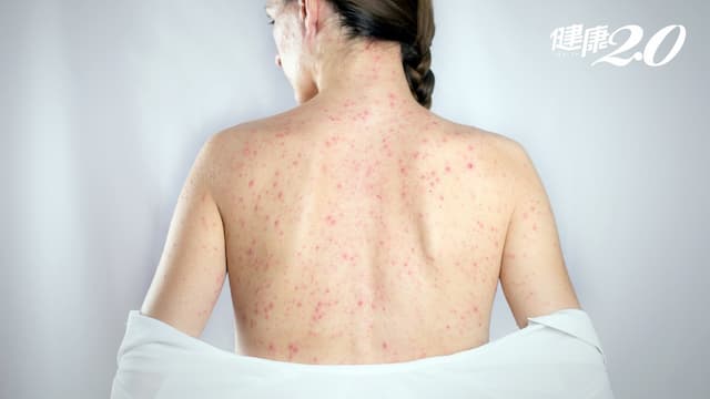 22歲女大生打3劑新冠疫苗 引發嚴重藥疹！免疫抑制劑挽救皮膚生機