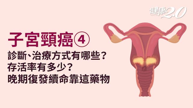 子宮頸癌／診斷方法有哪些？不同期別如何治療？晚期復發1藥物助延命/encyclopedia/335485