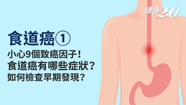 食道癌／9成病人都有這個症狀！為什麼會得食道癌？「愛喝1物」罹癌機會大