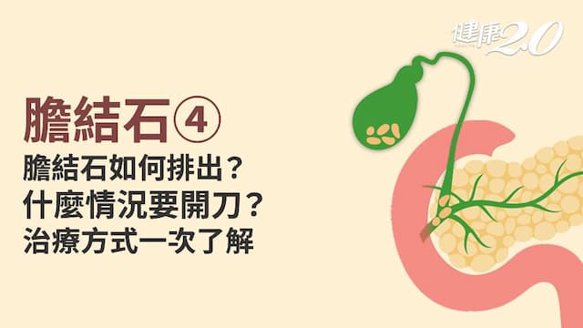 膽結石／膽結石一定要開刀嗎？膽囊切除會怎樣？1療法疼痛消失不復發