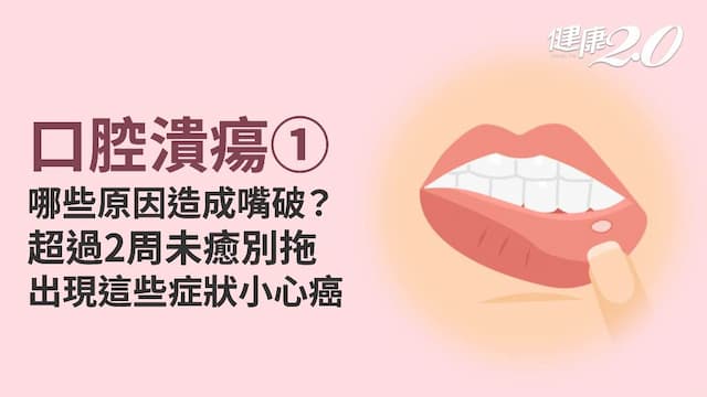 口腔潰瘍／為什麼老是嘴破？原因不只是咬到或火氣大！超過2周沒痊癒要小心癌變