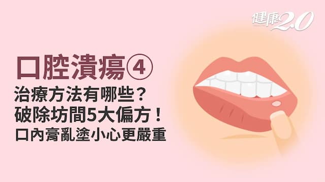 口腔潰瘍／可自行擦口內膏就好？噴西瓜霜有效嗎？正確治療一次搞懂