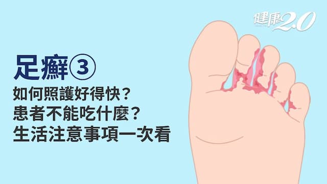 足癬／香港腳能不能根治？患者照護12字訣＋3飲食禁忌 有助消滅黴菌