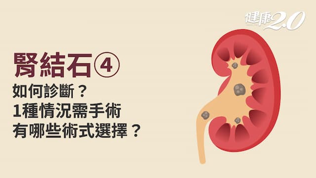 腎結石／腎結石一定要手術？超過這大小建議治療 3種手術方式報你知