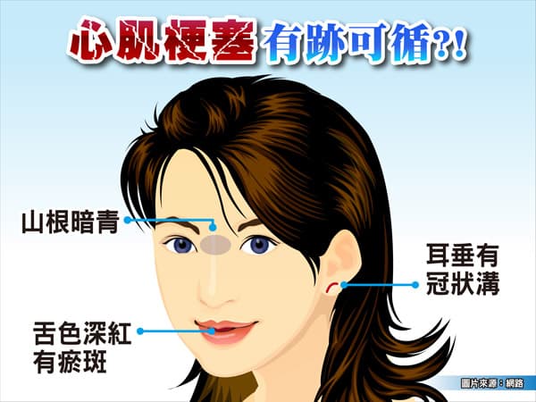 3/12《我會「心肌梗塞」嗎？抓出你忽略的發病前兆》重點回顧