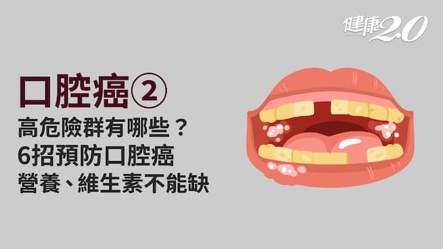 口腔癌／預防口腔癌很簡單！癌變容易自我發現 高危險群潰瘍5現象快就醫