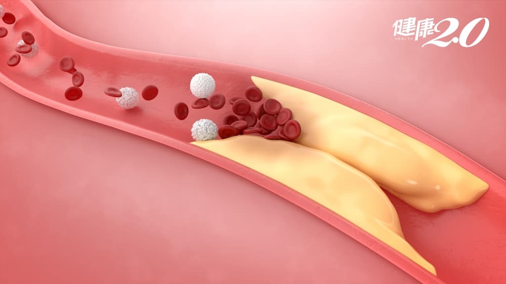 如何降血脂最有效？降膽固醇、降三酸甘油酯方法大不同 這方法有機會不吃藥