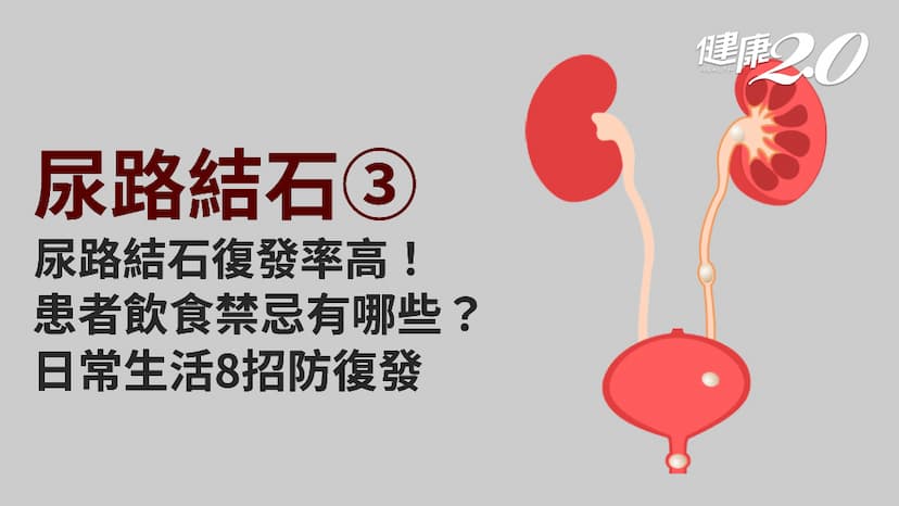 尿路結石／尿路結石5年復發率高達5成！患者日常要注意什麼？哪些食物不要吃？/encyclopedia/339759